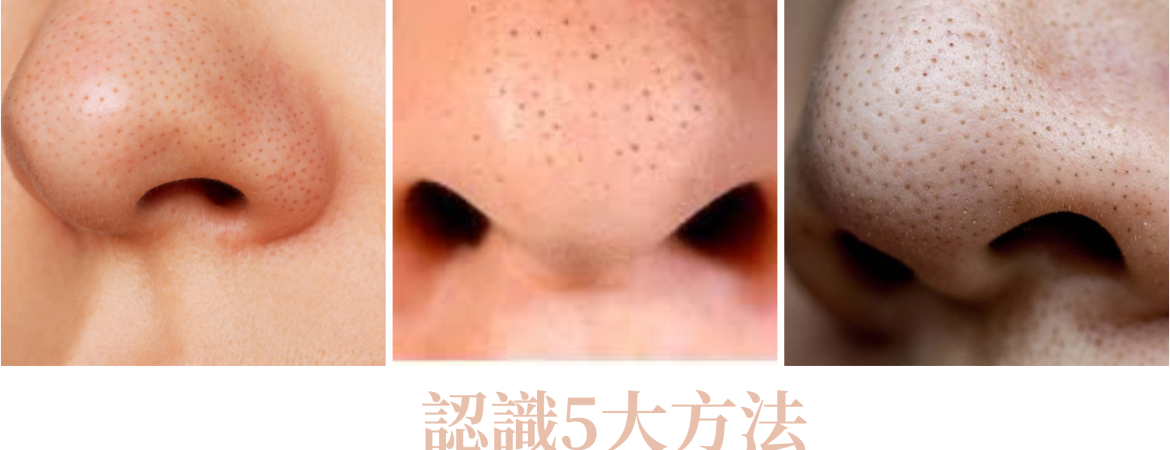 【去黑頭】認識5大方法、粉刺是什麼及破解錯誤清除方法