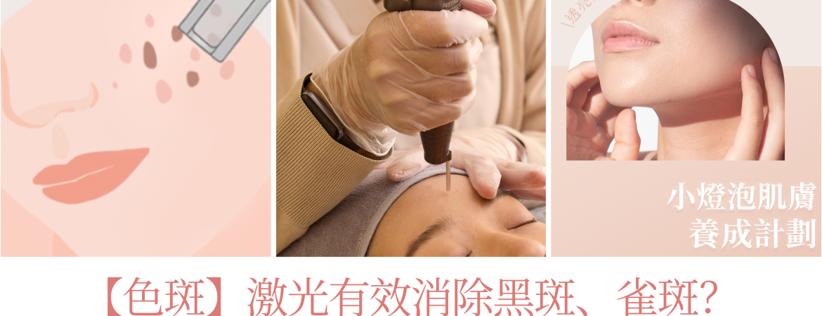 激光有效消除黑斑、雀斑？一文睇清色斑成因、類型、去斑方法！